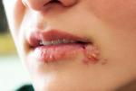 Genital Herpes Ayurveda Treatment  Riyadh